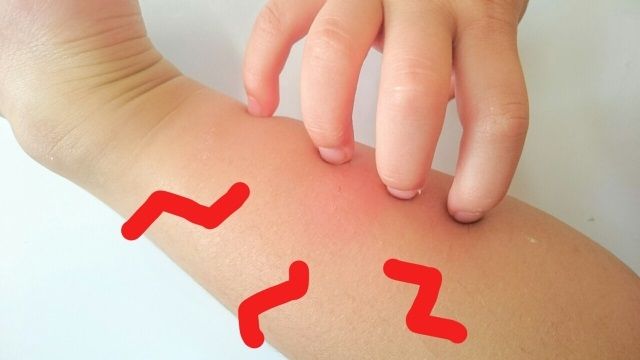 チャドクガ皮膚炎はうつることがある?二次被害に注意